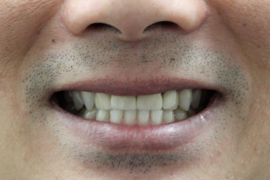 Before photo, smile makeover case 2 at Smiley Cypress Dental Care