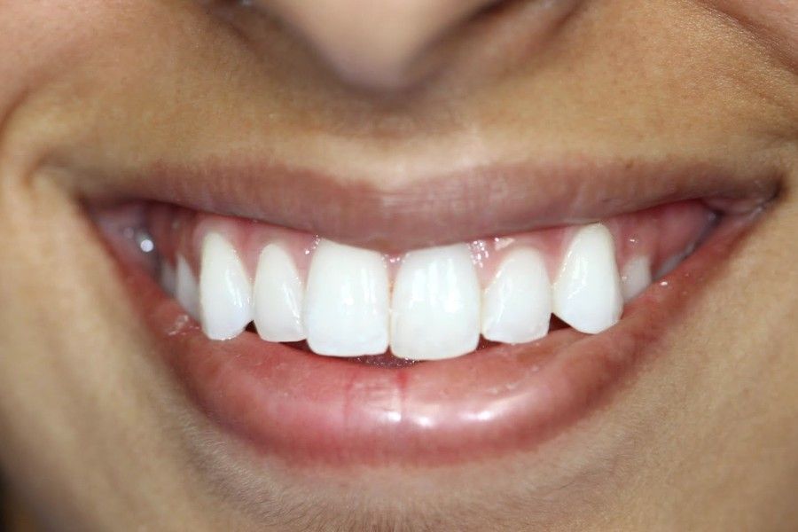 After photo, smile makeover case 3 at Smiley Cypress Dental Care