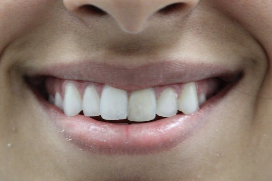 Before photo, smile makeover case 3 at Smiley Cypress Dental Care