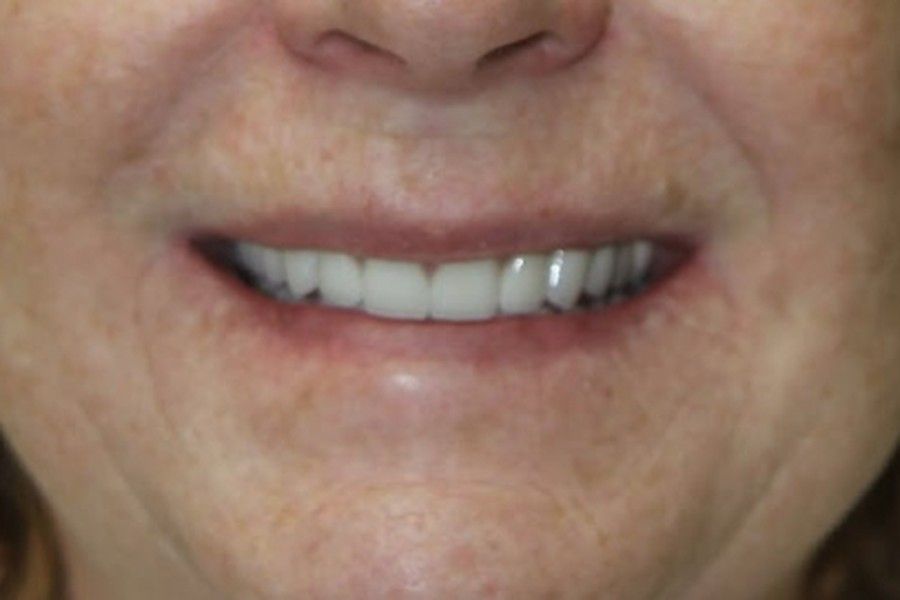 After photo, smile makeover case 4 at Smiley Cypress Dental Care