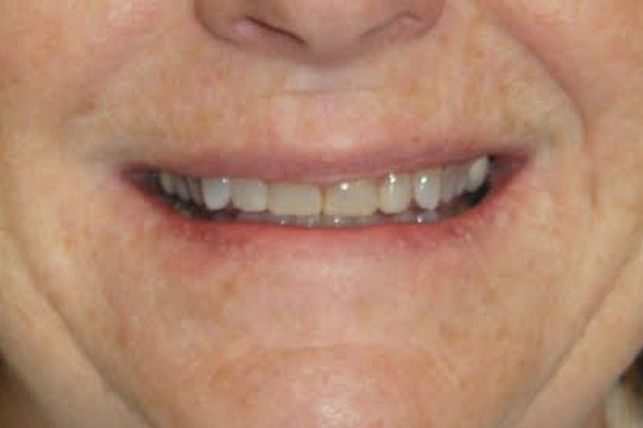 Before photo, smile makeover case 4 at Smiley Cypress Dental Care