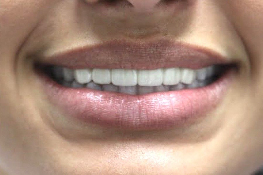 After photo, smile makeover case 5 at Smiley Cypress Dental Care