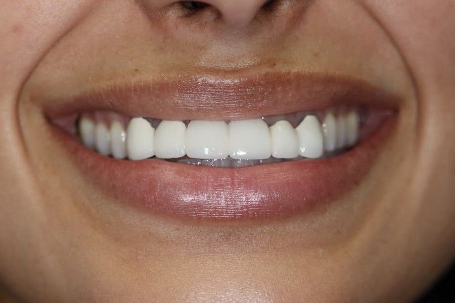 Before photo, smile makeover case 5 at Smiley Cypress Dental Care