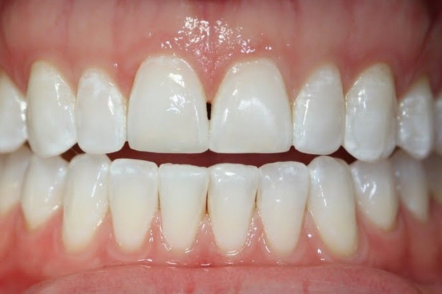After photo, smile makeover case 8 at Smiley Cypress Dental Care