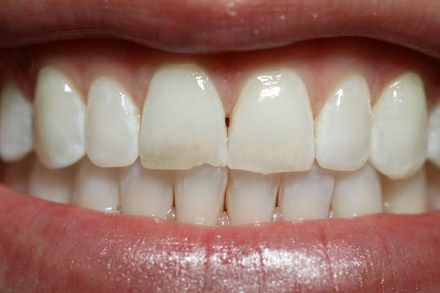 Before photo, smile makeover case 8 at Smiley Cypress Dental Care