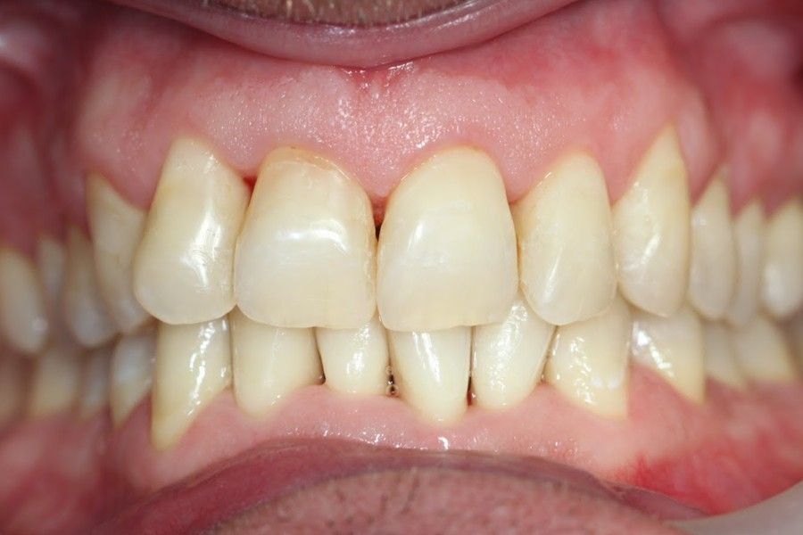After photo, front view, smile makeover case 9 at Smiley Cypress Dental Care
