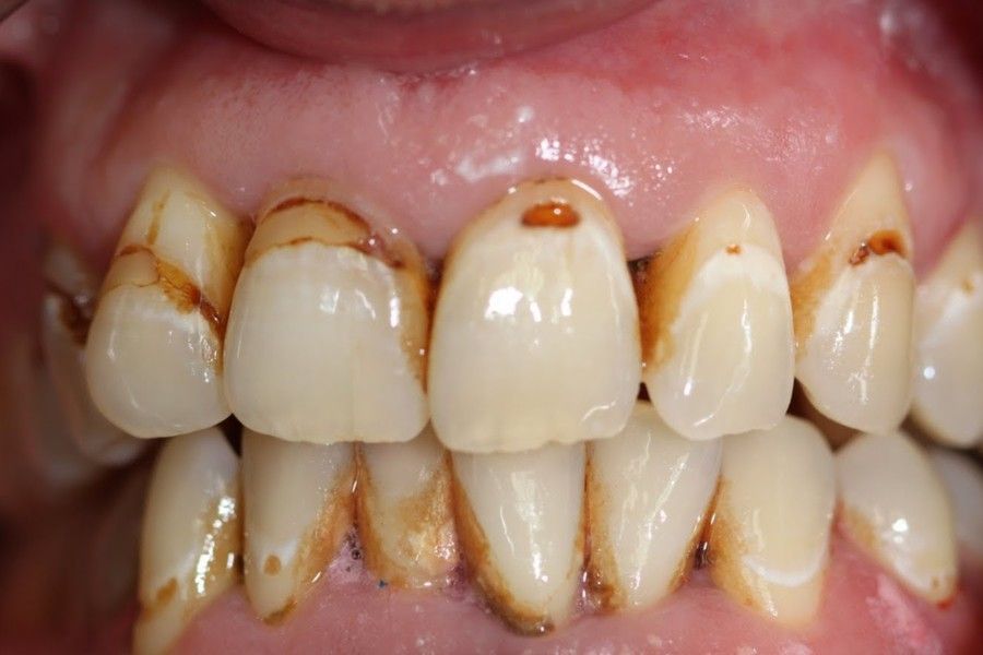 Before photo, front view, smile makeover case 9 at Smiley Cypress Dental Care