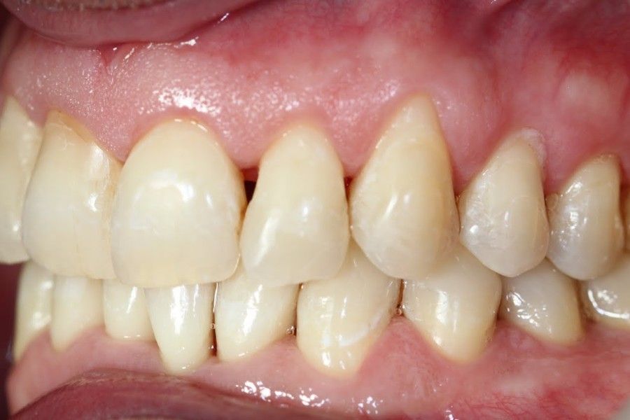 After photo, left view, smile makeover case 9 at Smiley Cypress Dental Care