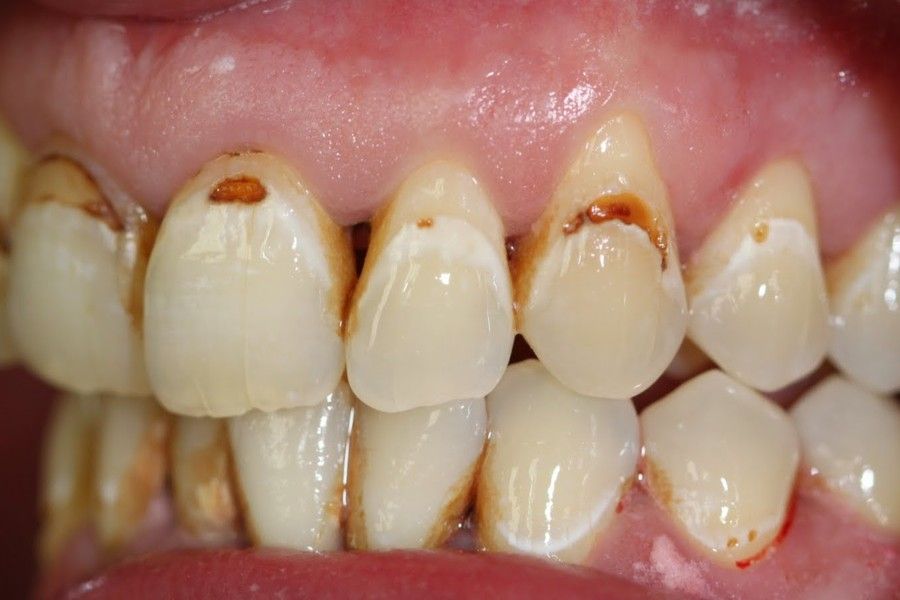 Before photo, left view, smile makeover case 9 at Smiley Cypress Dental Care