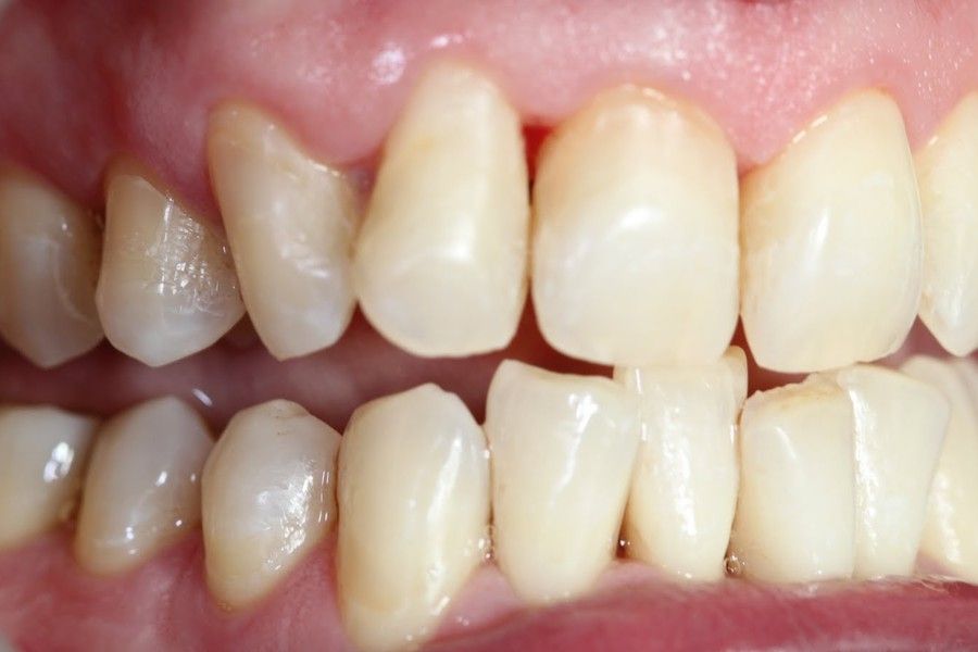 After photo, right view, smile makeover case 9 at Smiley Cypress Dental Care