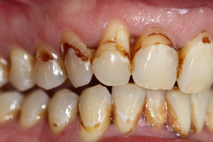 Before photo, right view, smile makeover case 9 at Smiley Cypress Dental Care